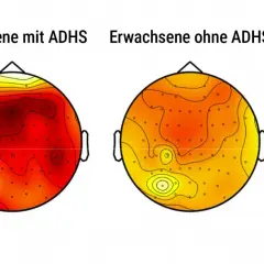 Vergleich des ADHS-Gehirns: Erwachsene mit ADHS zeigen höhere Hirnwellenaktivität (rot) als Erwachsene ohne ADHS (gelb).