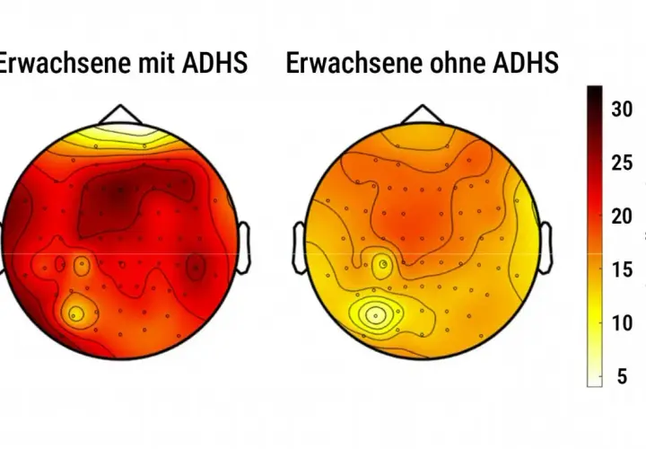 Vergleich des ADHS-Gehirns: Erwachsene mit ADHS zeigen höhere Hirnwellenaktivität (rot) als Erwachsene ohne ADHS (gelb).
