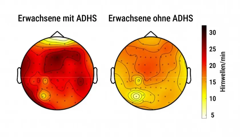 Vergleich des ADHS-Gehirns: Erwachsene mit ADHS zeigen höhere Hirnwellenaktivität (rot) als Erwachsene ohne ADHS (gelb).