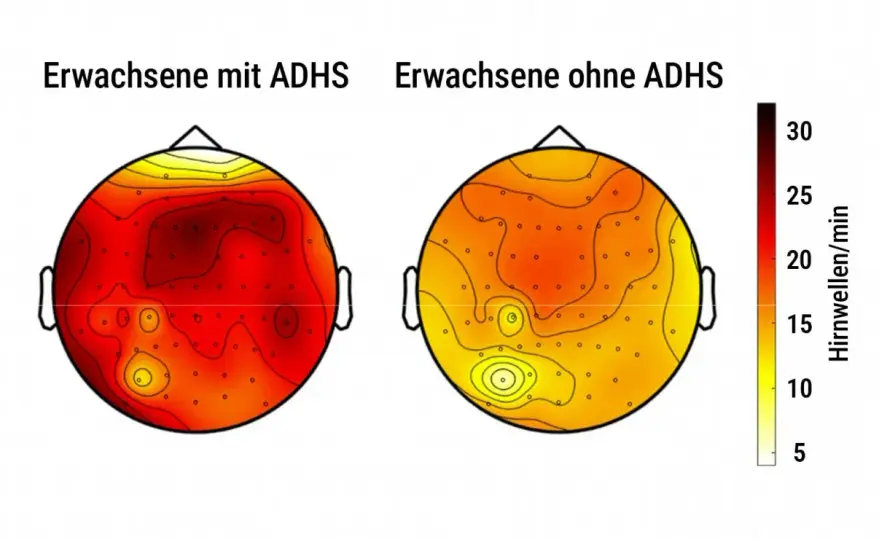 ADHS Gehirn Vergleich - Förderung in der Grundschule verstehen