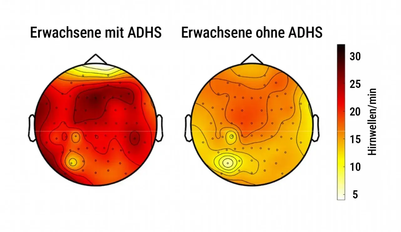 Vergleich des ADHS-Gehirns: Erwachsene mit ADHS zeigen höhere Hirnwellenaktivität (rot) als Erwachsene ohne ADHS (gelb).